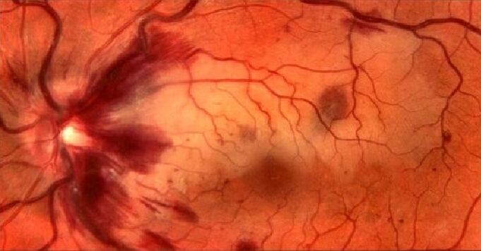 blood vessels of the restoration of the retina and the vision